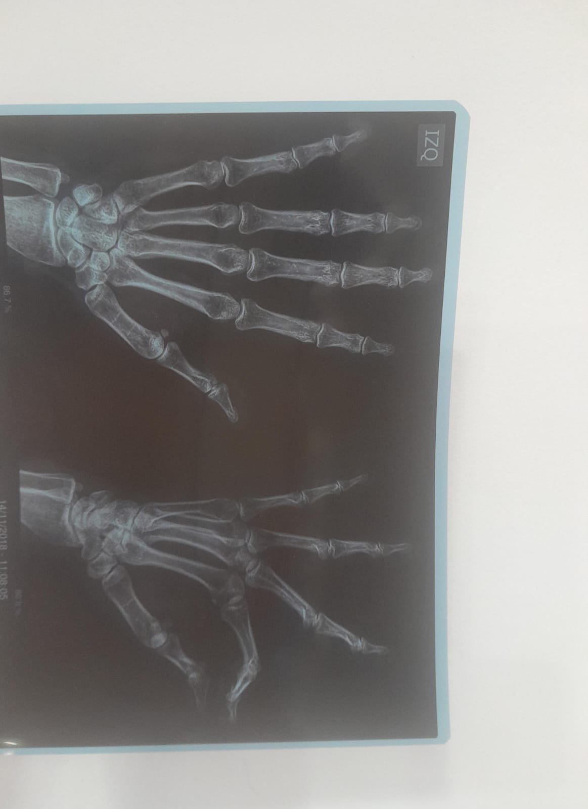 Radiografía educativa de mano izquierda