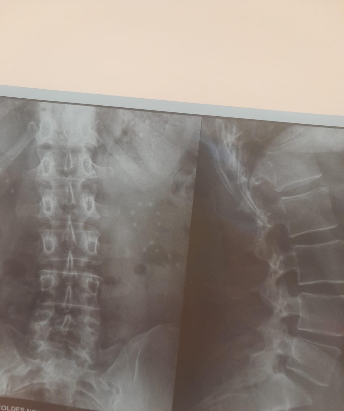 Miniatura de radiografía lumbar