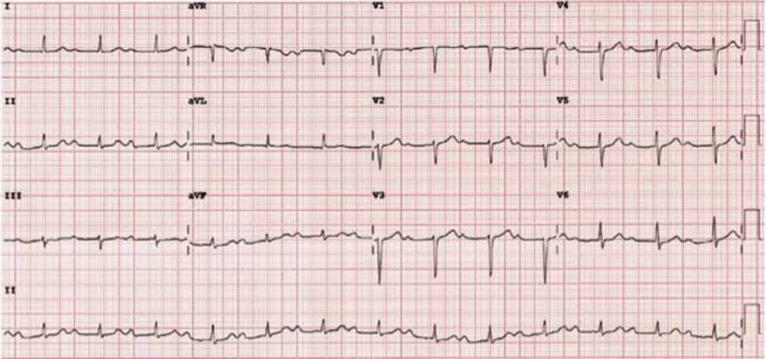 Miniatura de ECG